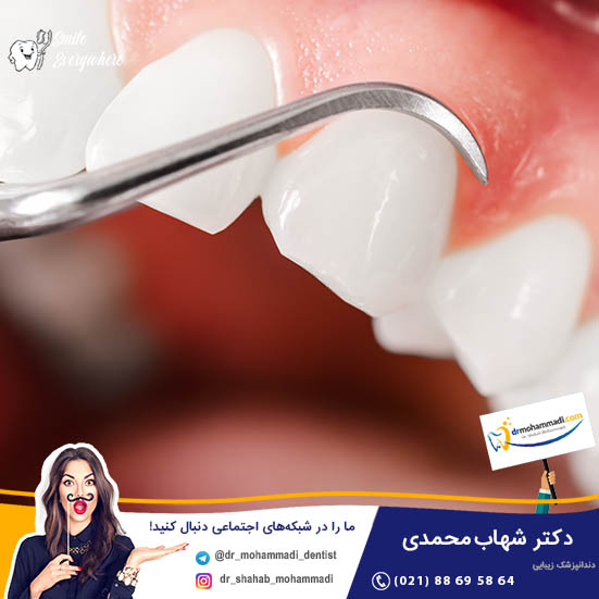 عفونت بعد از لیفت لثه - کلینیک دندانپزشکی دکتر شهاب محمدی